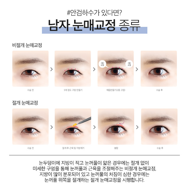 자연스러운 남자쌍꺼풀수술 에이비성형외과에서 만나 관련 이미지 4