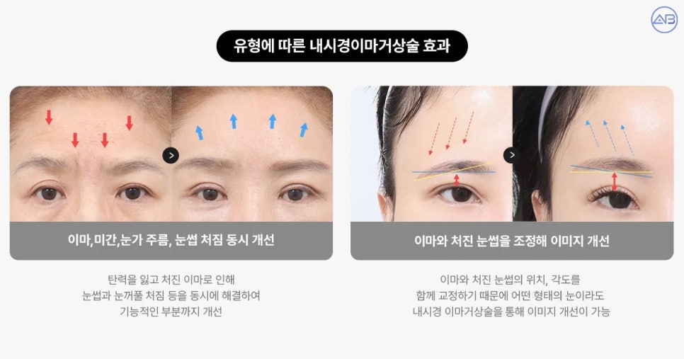 AB Plastic Surgery Endoscopic Forehead Lift: Key to Improving Eye Appearance Before and After Changes! image 2