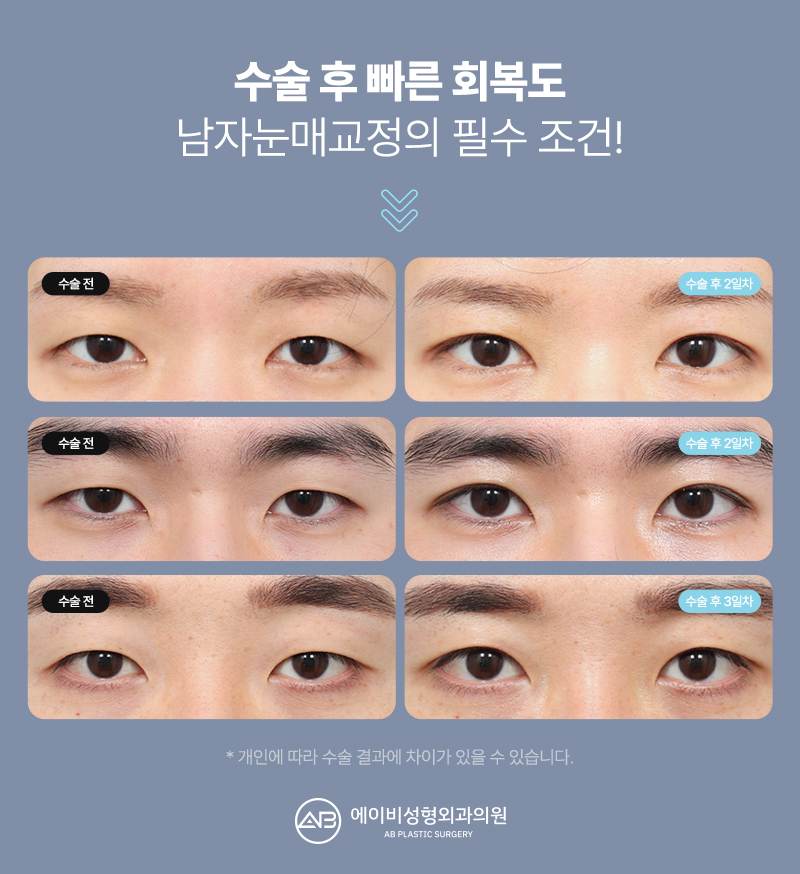 남자눈매교정 잘하는 에이비성형외과 다른점은 뭘까? 관련 이미지 10