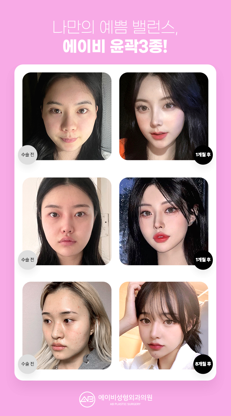 윤곽수술잘하는곳 볼 때 고려해야 할 점 관련 이미지 3