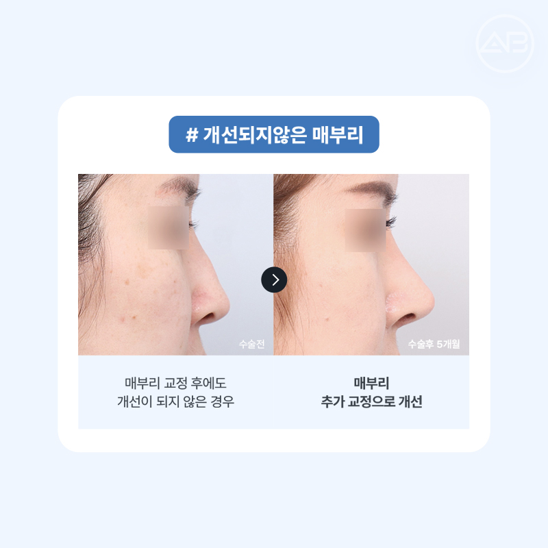 코재수술 필요하다면 에이비성형외과 관련 이미지 5