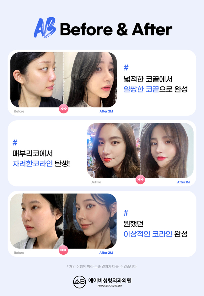 자려한코성형 에이비성형외과만의 차이점 관련 이미지 4