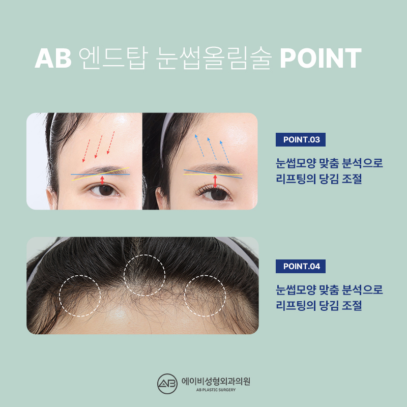What Is the Endtop Eyebrow Lift That So Many People in Their 20s and 30s Are Getting? image 4
