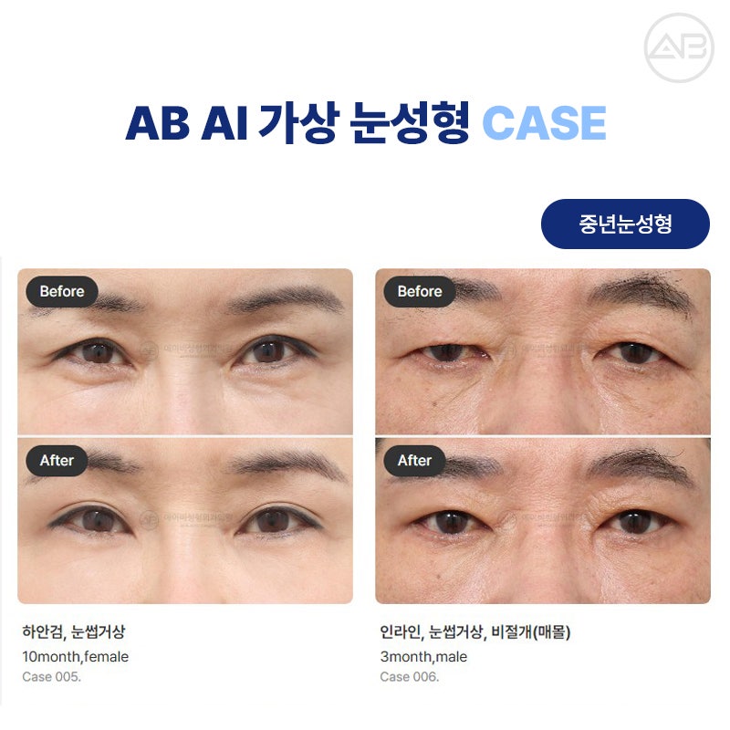 에이비성형외과 AI 가상 눈성형 원하는 결과를 미리 볼 수 있다! 관련 이미지 6
