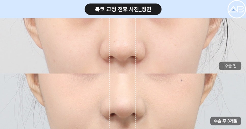 복코성형 전후효과 보려면? (Faet. 에이비성형외과 서찬얼원장) 관련 이미지 7