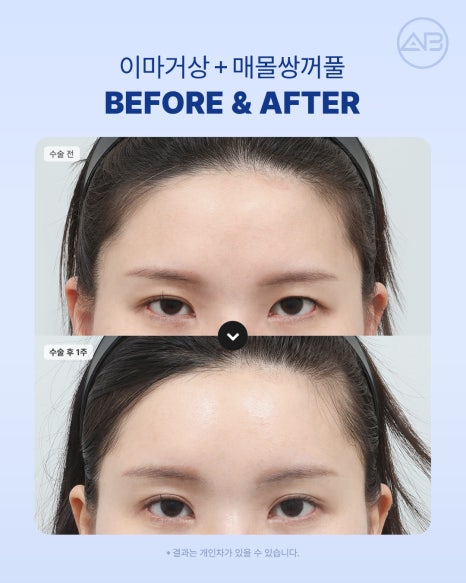 에이비성형외과 눈꺼풀처짐을 바꾸는 이마거상수술의 역할 알아보기 관련 이미지 6