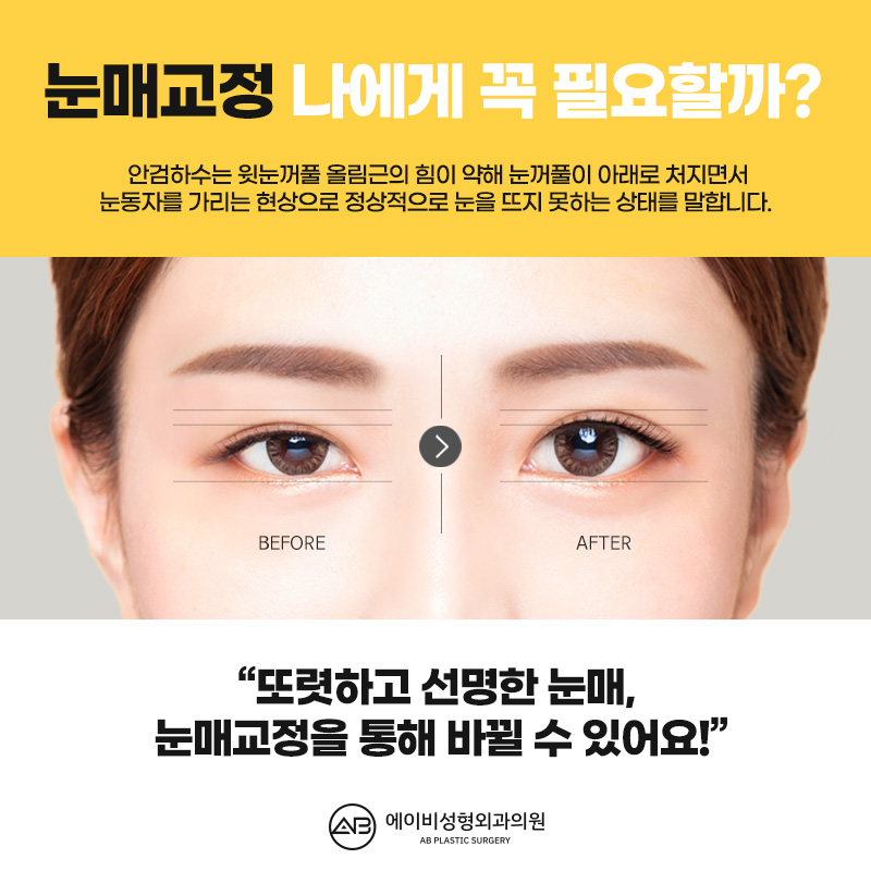 눈뜨는 힘이 부족하다면 에이비 안검하수눈매교정 관련 이미지 3