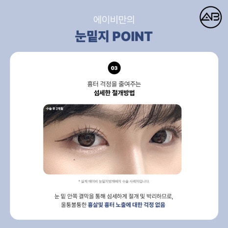 에이비성형외과의원 눈밑지방재배치 눈밑지 수술 방법 후기 관련 이미지 7