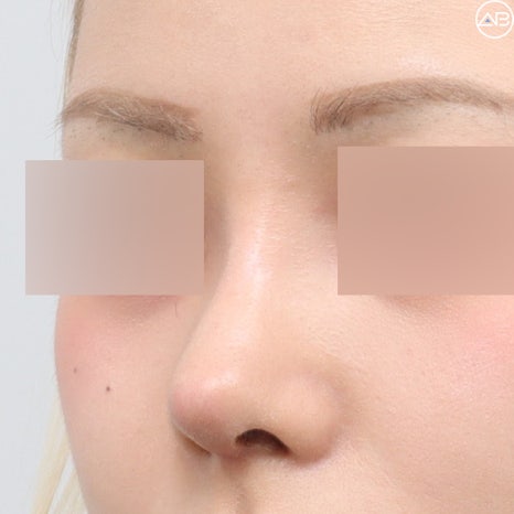 AB Plastic Surgery Natural Glamorous Rhinoplasty Case Review (Feat. Dr. Jo Gyu-sang) image 8