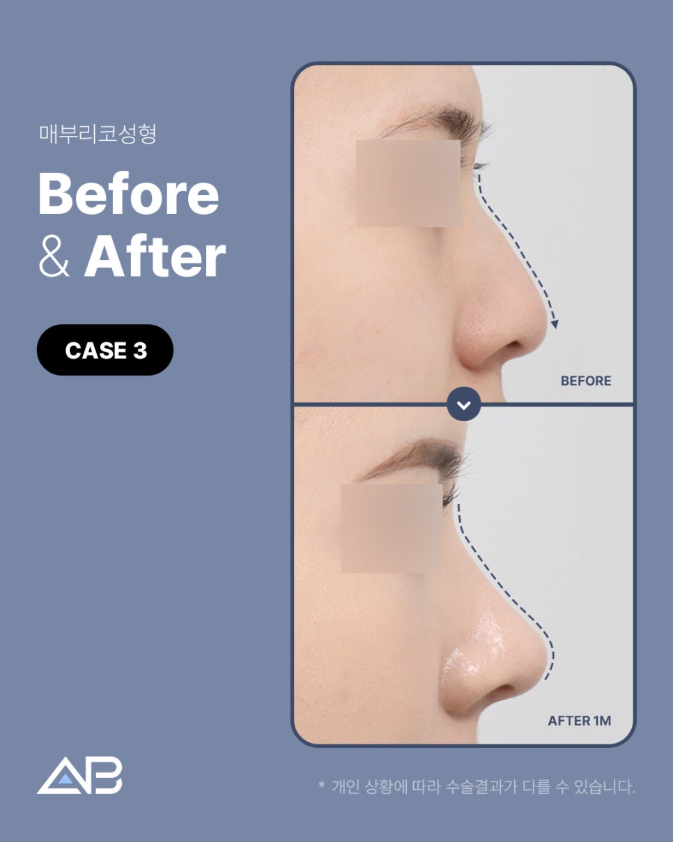 매부리코성형 자연스럽게 교정 원한다면 AB성형외과 관련 이미지 6