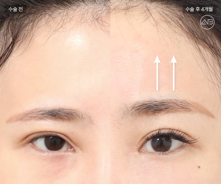AB Plastic Surgery Endoscopic Forehead Lift: Key to Improving Eye Appearance Before and After Changes! image 1