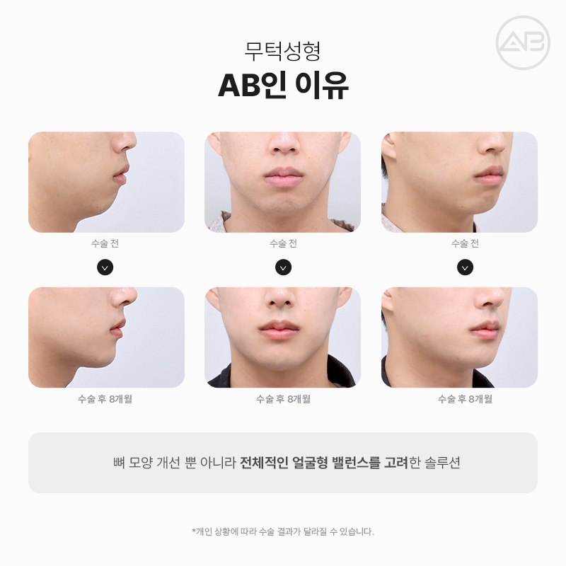 무턱성형 고려하고 있다면 AB성형외과 관련 이미지 10