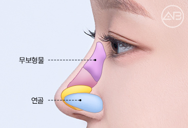 Learn About and Decide on AB Plastic Surgery’s Hump Nose Correction and Implant-Free Rhinoplasty image 6