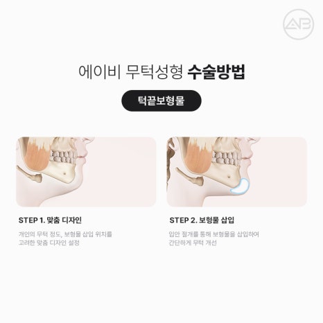 무턱성형 고려하고 있다면 AB성형외과 관련 이미지 5