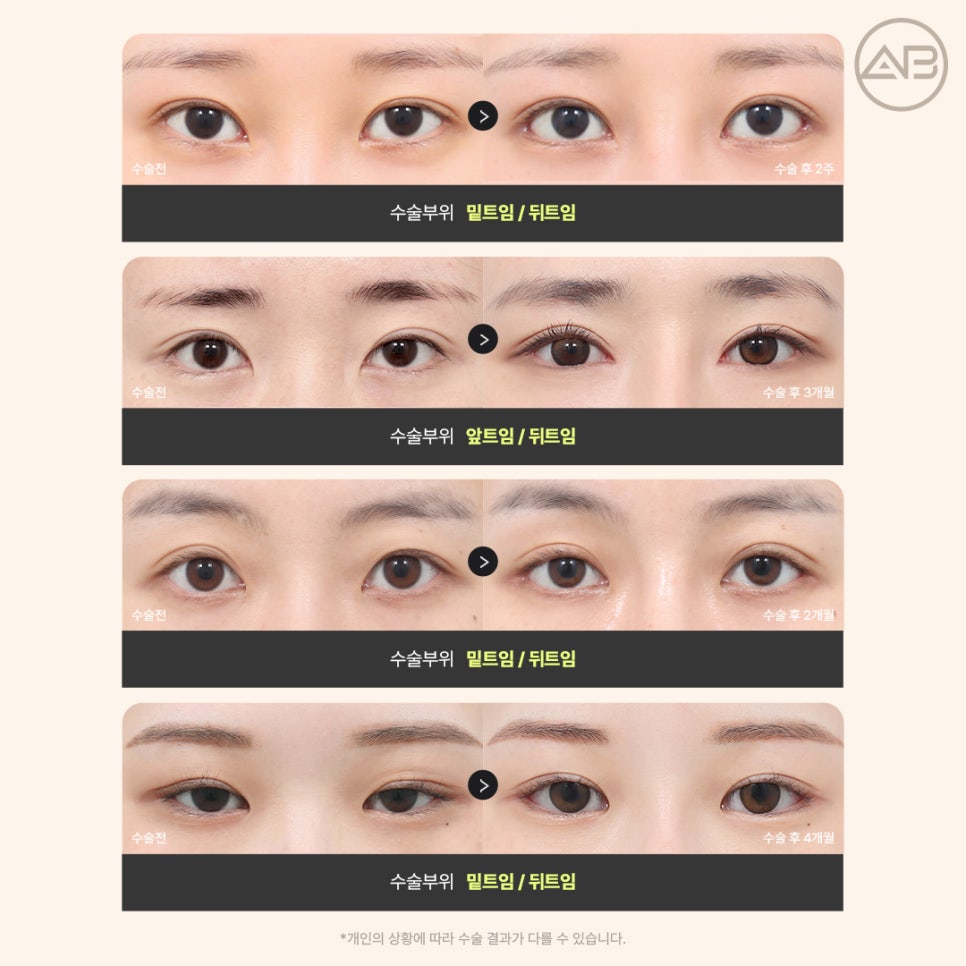 AB Plastic Surgery Eye Corner Surgery: Types and Reviews of Epicanthoplasty, Canthoplasty, and Lower Canthoplasty image 13