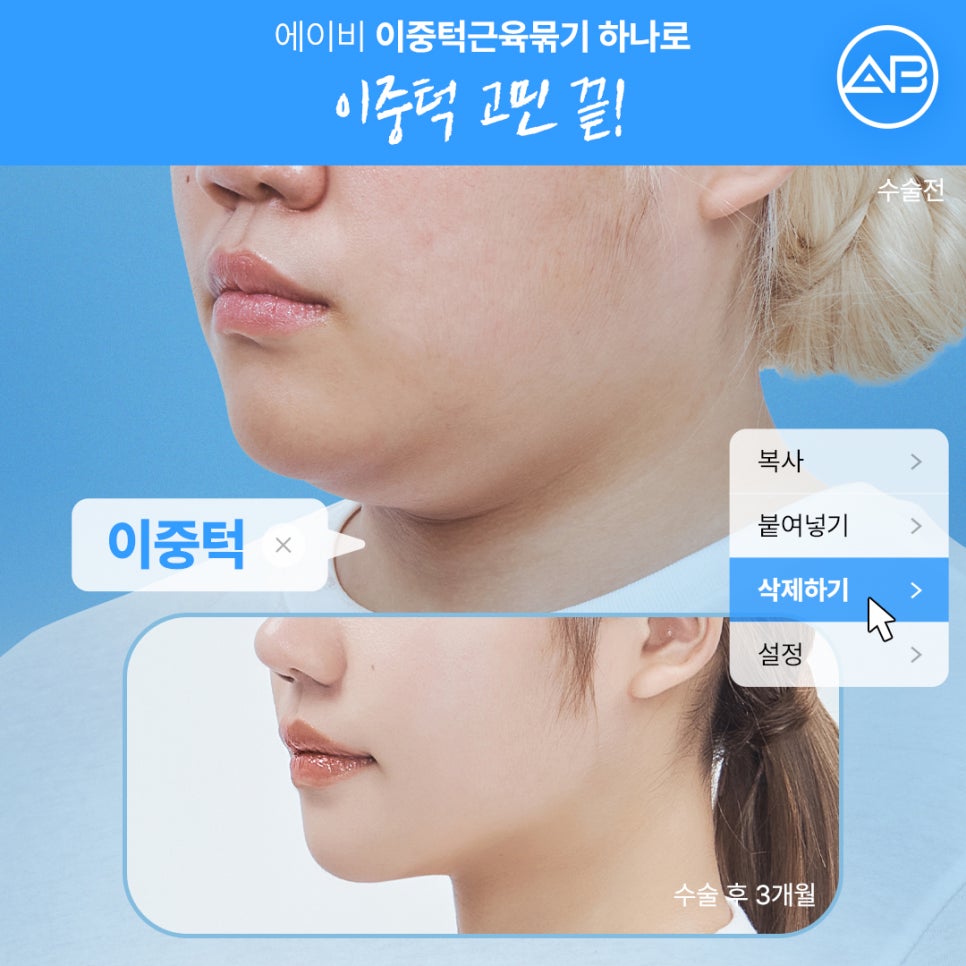 The Secret to a Slim Jawline, AB Plastic Surgery Double Chin Muscle Binding image 2