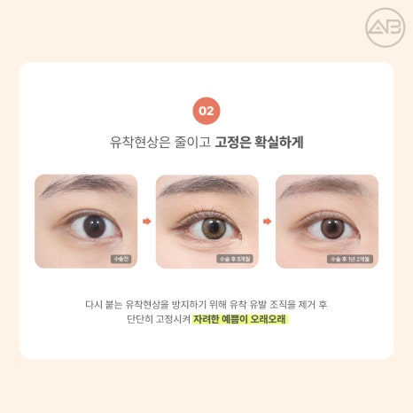 AB Plastic Surgery Eye Corner Surgery: Types and Reviews of Epicanthoplasty, Canthoplasty, and Lower Canthoplasty image 8