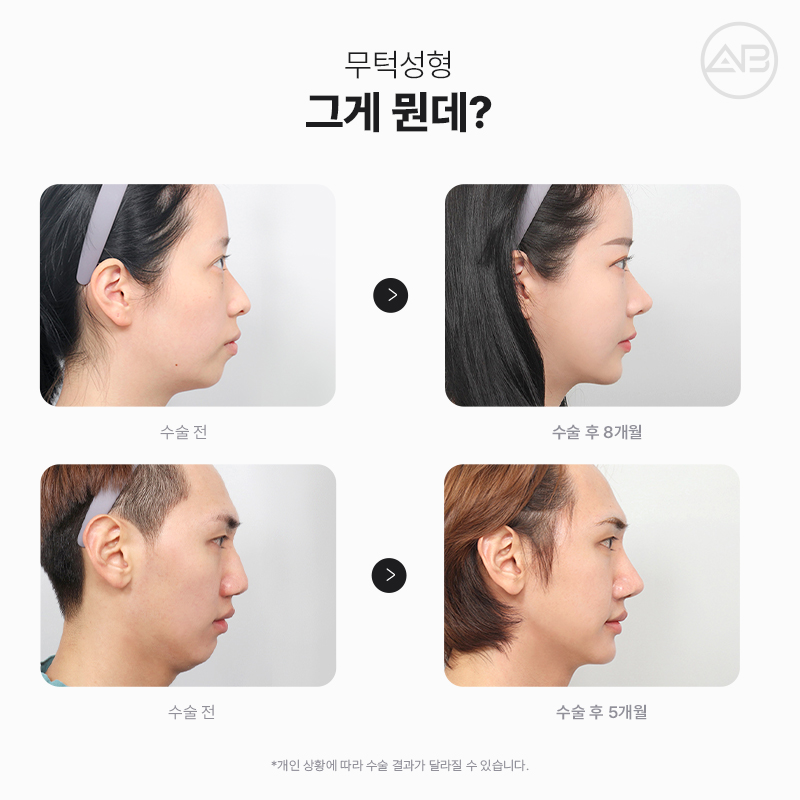 무턱성형 고려하고 있다면 AB성형외과 관련 이미지 2