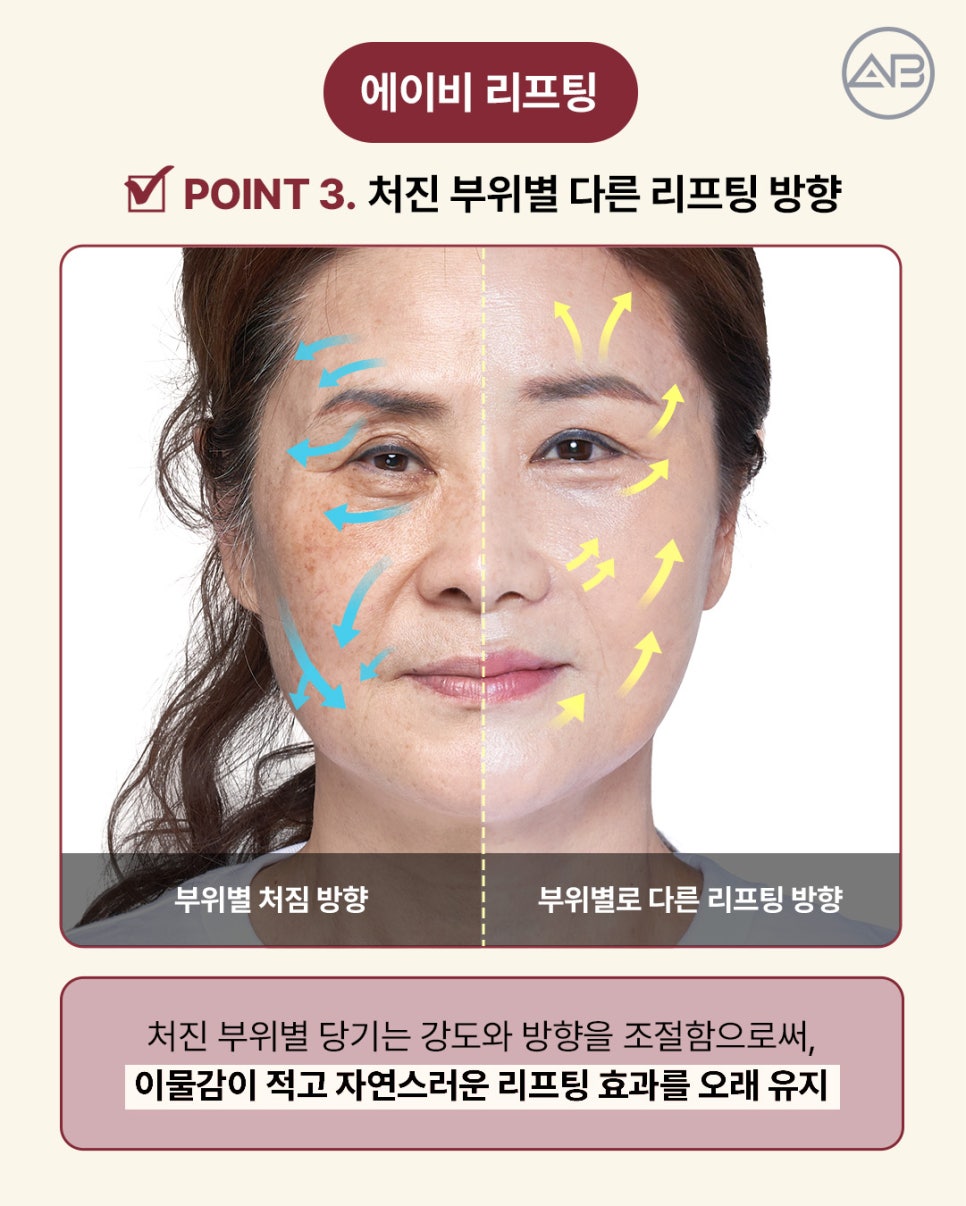 AB Plastic Surgery: Aging-Specific Step-by-Step Lifting (Mini Lift, Semi-Full Lift, Full SMAS Facelift) image 7