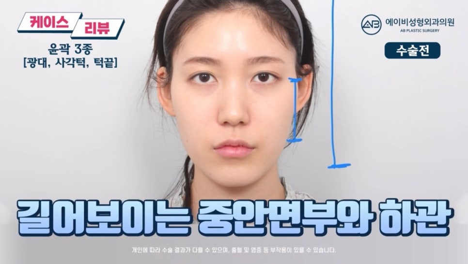 #에이비성형외과#에이비tv#케이스리뷰#안면윤곽성형 관련 이미지 1