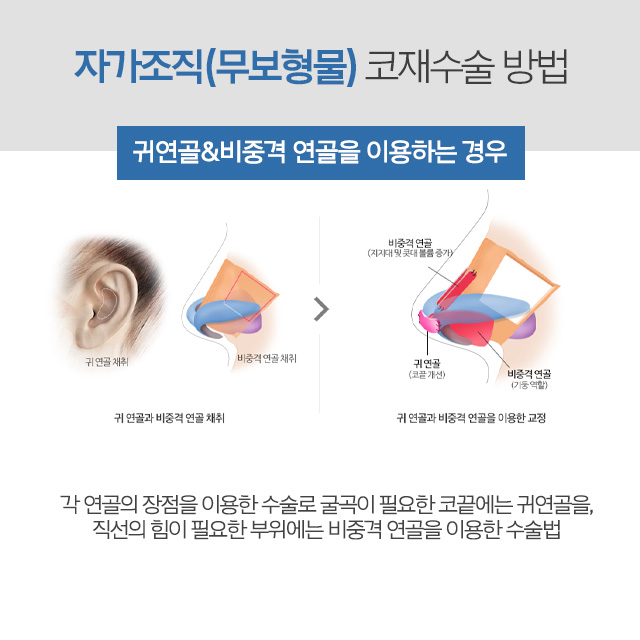 코재수술비용 고민이라면 AB성형외과에서 알아봐 관련 이미지 7