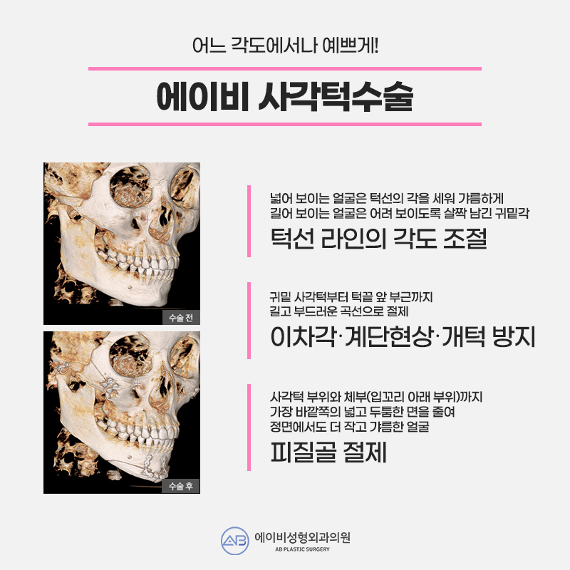 안면윤곽3종수술 솔루션은 에이비! 관련 이미지 4