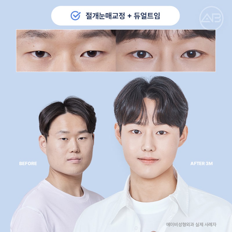 인상을 바꾸는 첫 시작, 에이비성형외과 남자눈성형 관련 이미지 20