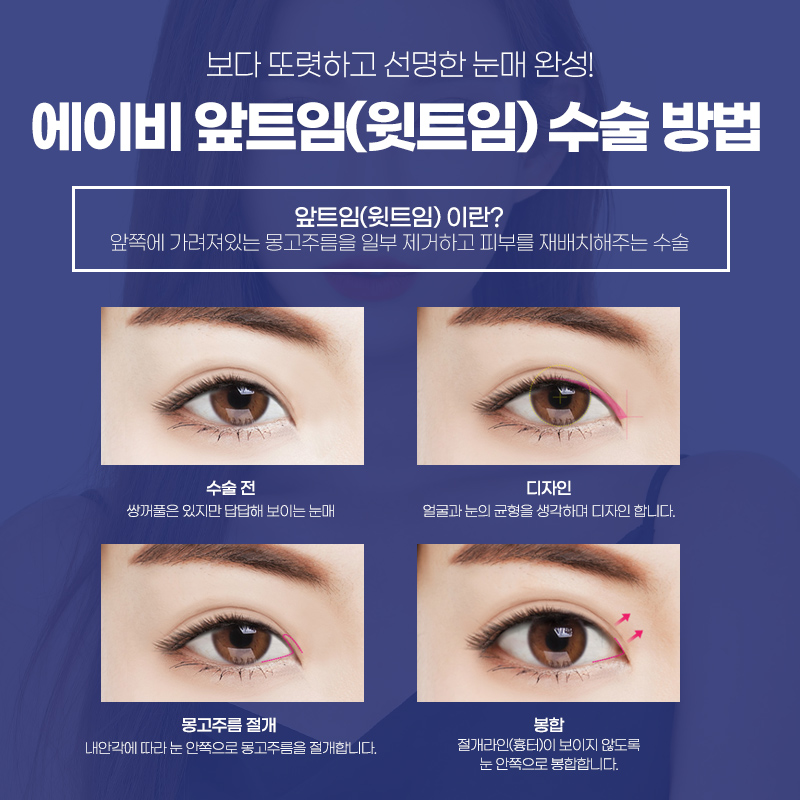 앞트임전후 달라짐을 느껴봐 관련 이미지 2