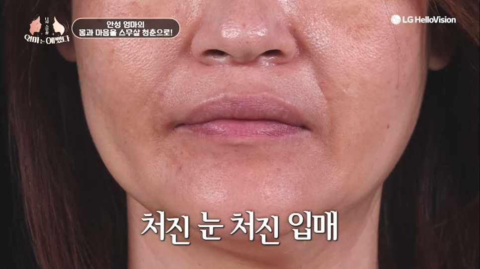 [에이비성형외과 방송출연] 엄마는예뻤다 7회 안성엄마 전후모습 다시보기 관련 이미지 13