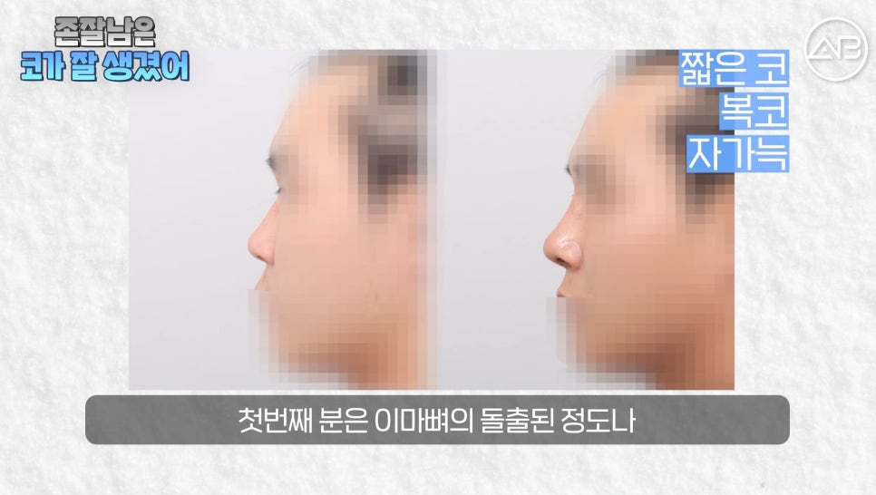 #AB Plastic Surgery #AB TV #Male Nose Surgery #Nose Surgery image 10