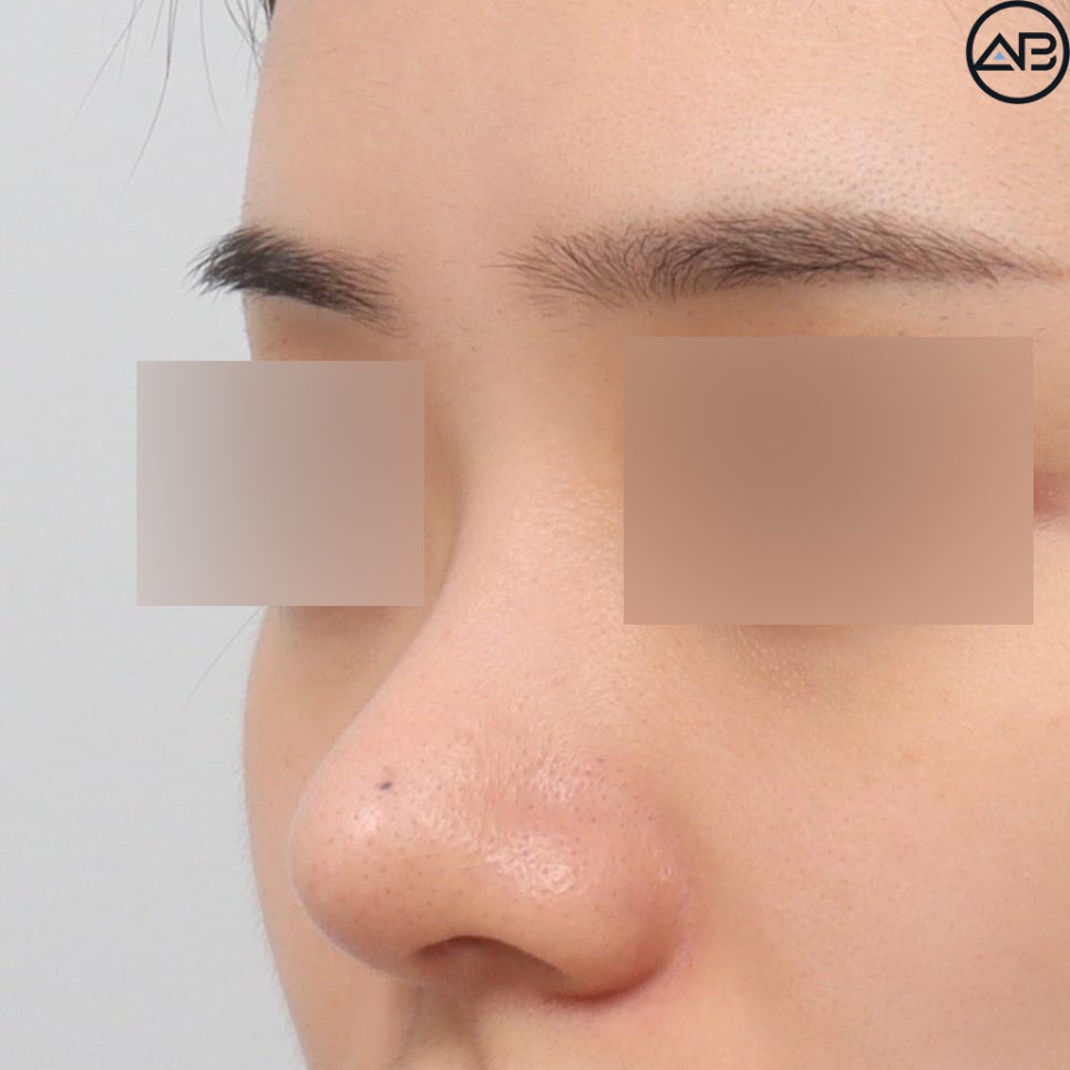 AB Plastic Surgery Refined Rhinoplasty - Revision Surgery Case Review image 2