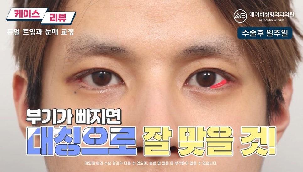 #에이비성형외과#에이비tv#눈성형#남자눈성형 관련 이미지 5