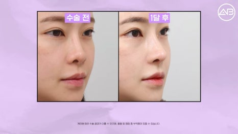 #AB Plastic Surgery #AB TV #Case Review #Nose Surgery #Revision Rhinoplasty image 8