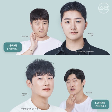 자려한안면윤곽 원한다면 AB성형외과 관련 이미지 14