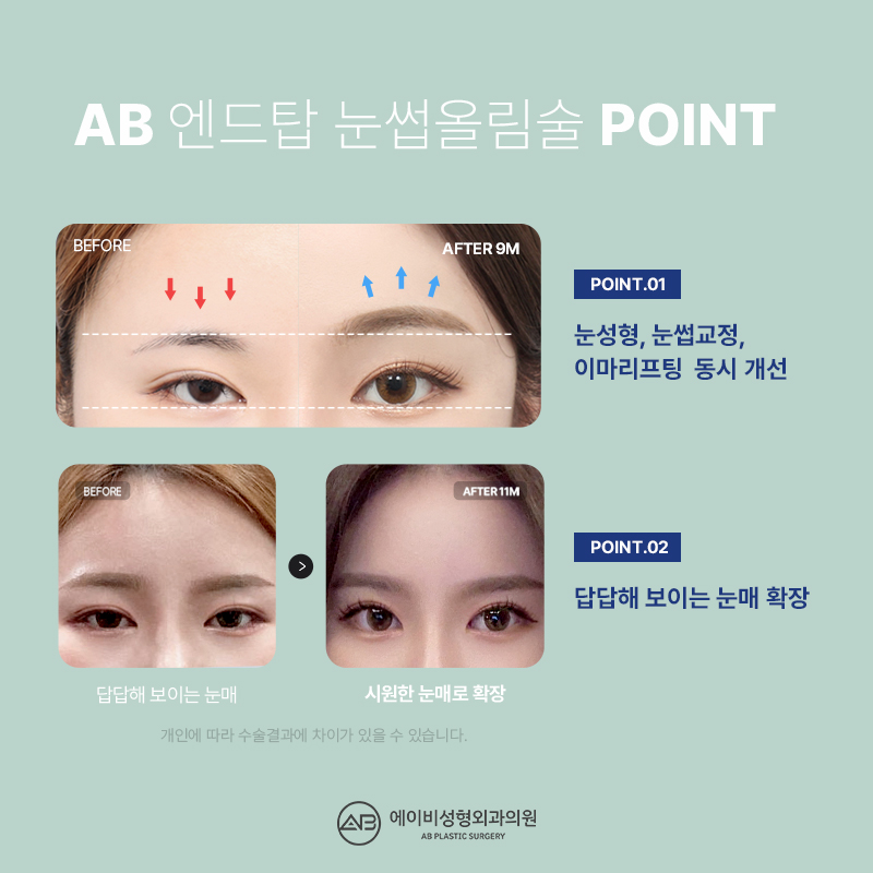 What Is the Endtop Eyebrow Lift That So Many People in Their 20s and 30s Are Getting? image 3