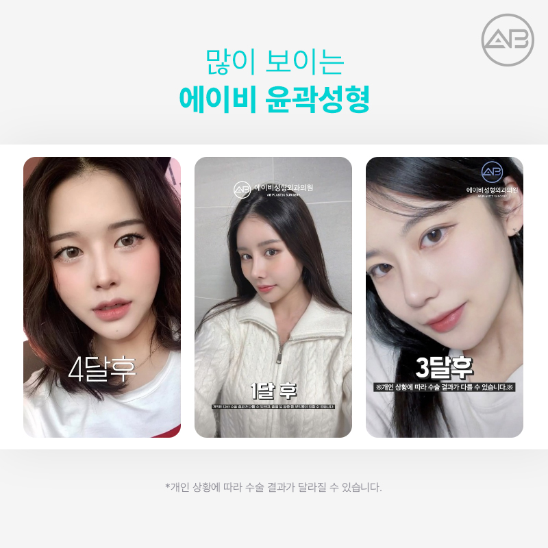에이비성형외과 광대축소 부드럽고 갸름하게 관련 이미지 6