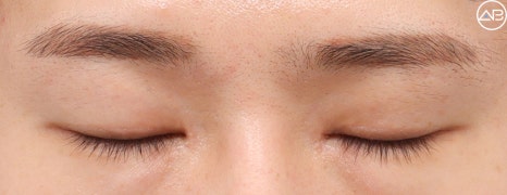 AB Plastic Surgery Male Eye Surgery Case Review (Feat. Director Ahn Moon-young) image 8