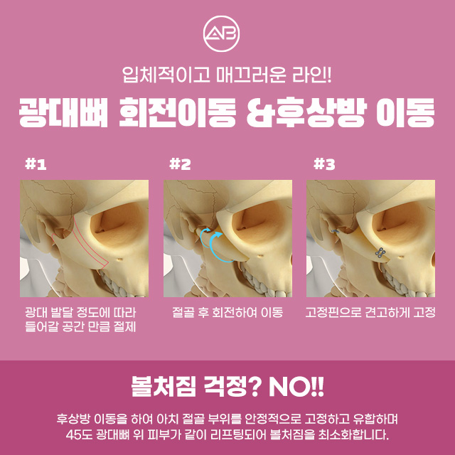AB성형외과 광대축소술 이라면 부드러운 광대라인 가능해 관련 이미지 4