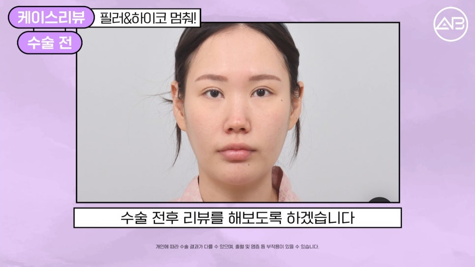 #에이비성형외과#에이비tv#케이스리뷰#코성형 관련 이미지 1