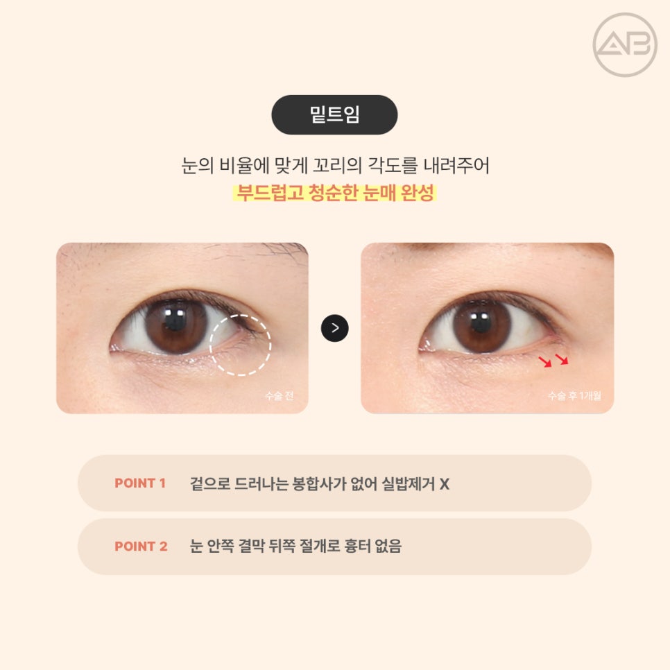 AB Plastic Surgery Eye Corner Surgery: Types and Reviews of Epicanthoplasty, Canthoplasty, and Lower Canthoplasty image 5