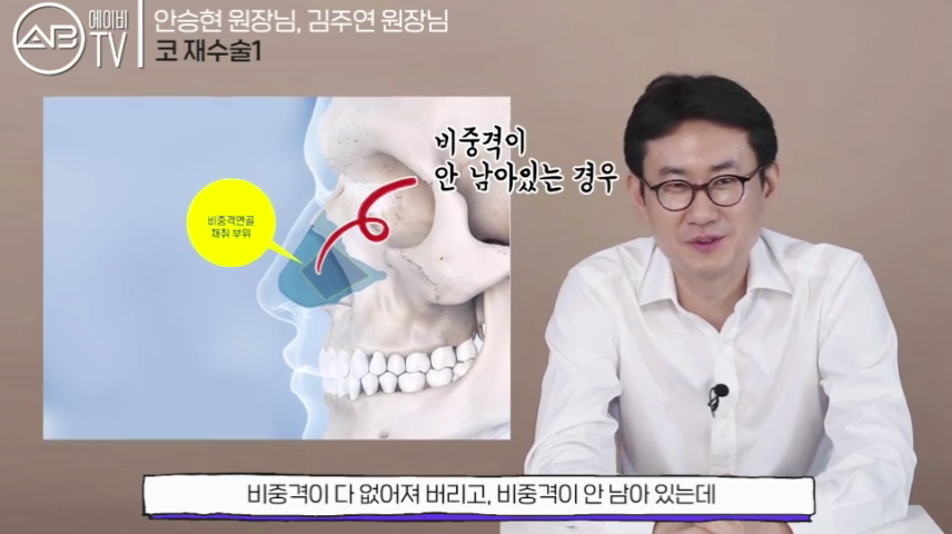 에이비성형외과 #유튜브 #에이비TV #코재수술 #코성형 관련 이미지 6