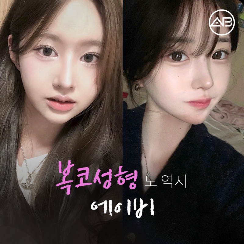 Why AB Plastic Surgery Is Famous for Bulbous Nose Surgery image 7
