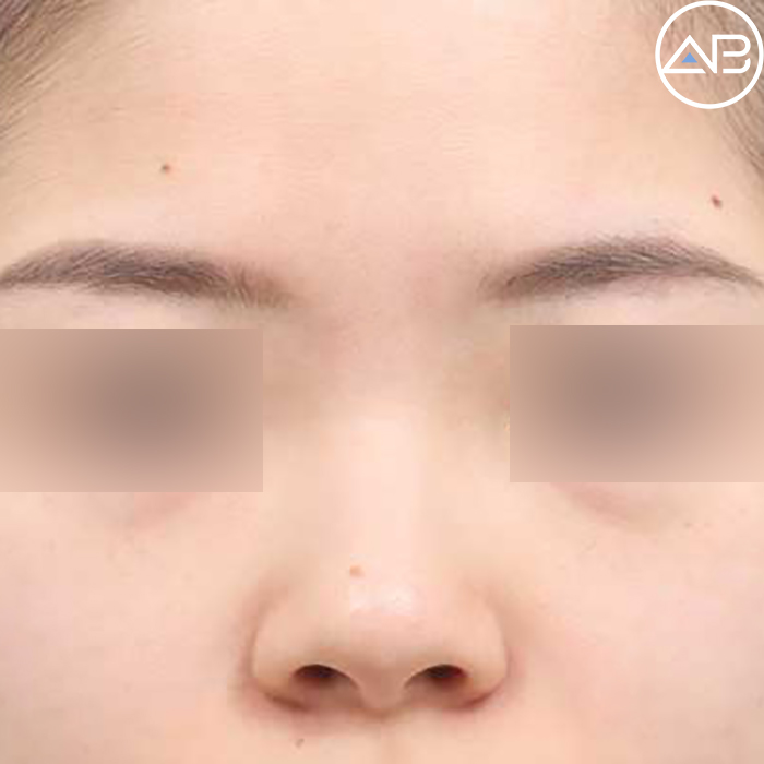 에이비성형외과 복코성형전후 케이스리뷰 (Faet.조규상원장) 관련 이미지 1