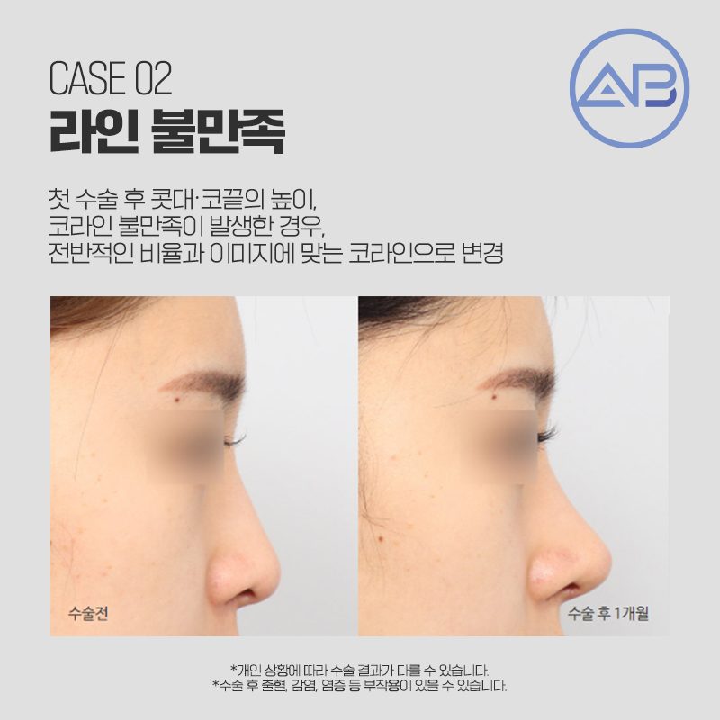 코재수술성형외과 에이비만 믿어! 관련 이미지 2