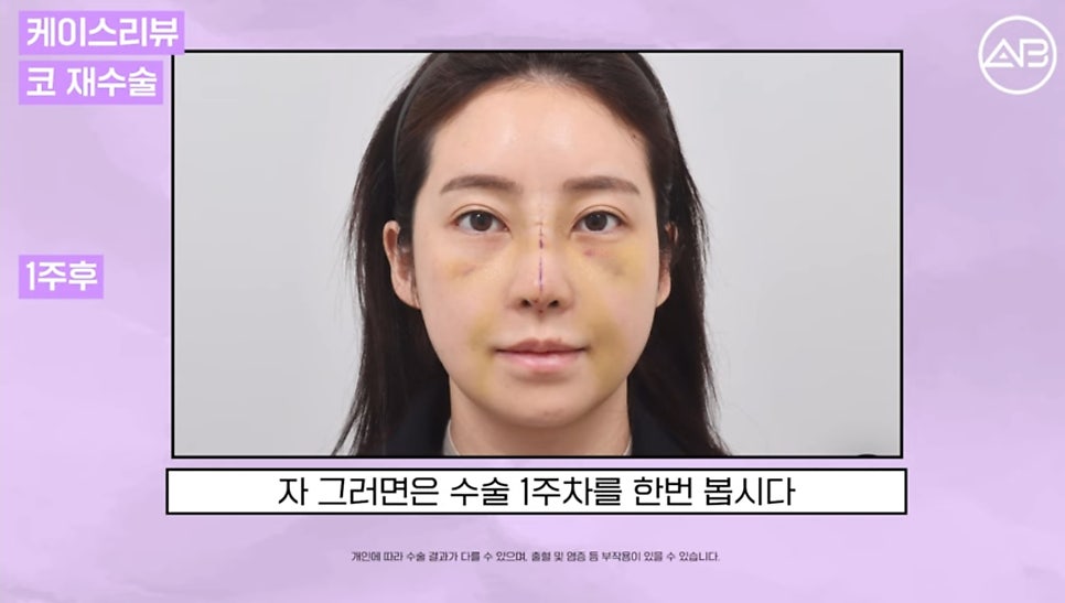 #AB Plastic Surgery #AB TV #Case Review #Nose Surgery #Revision Rhinoplasty image 4