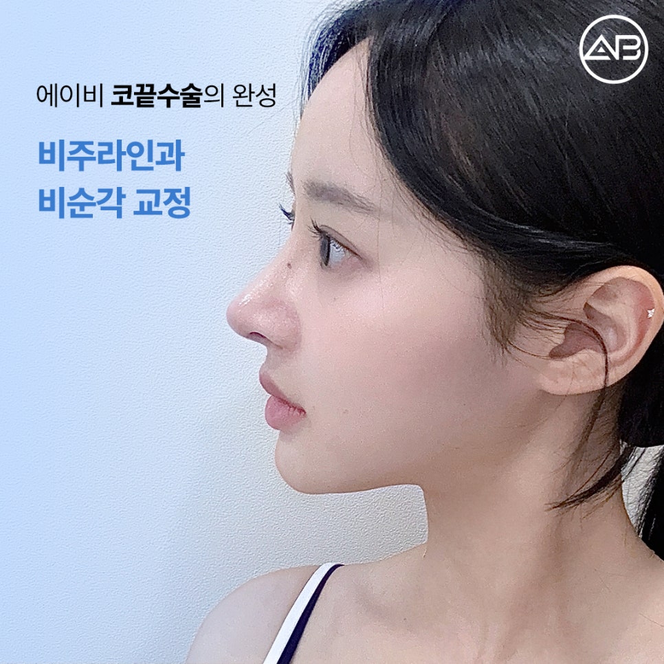 에이비성형외과 코끝수술전후 비주라인과 비순각교정수술이 중요한 이유 관련 이미지 1