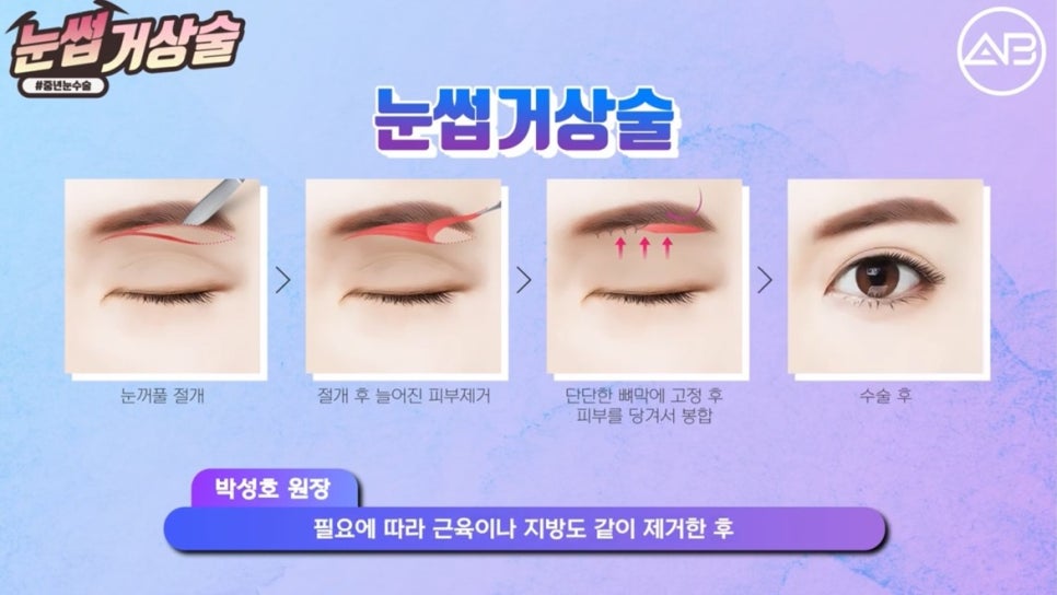 #에이비성형외과#에이비TV#눈성형#눈썹거상술 관련 이미지 2