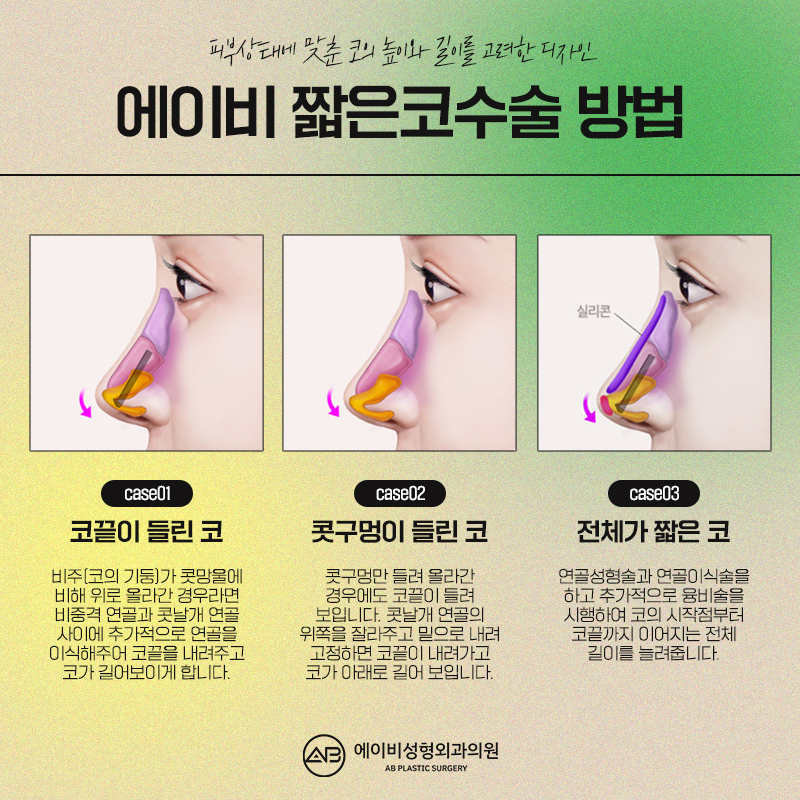 들창코수술 이런 변화가 관련 이미지 3
