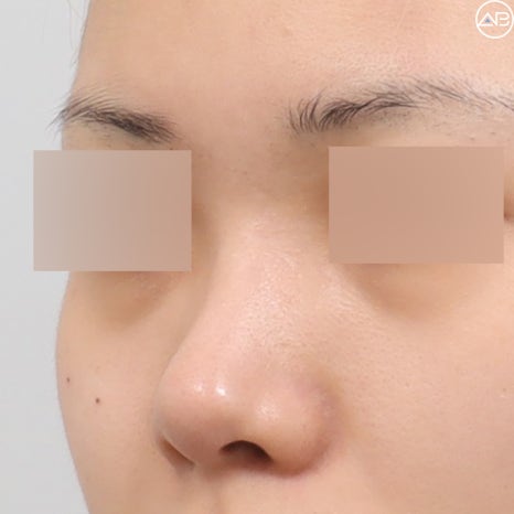 AB Plastic Surgery Natural Glamorous Rhinoplasty Case Review (Feat. Dr. Jo Gyu-sang) image 7