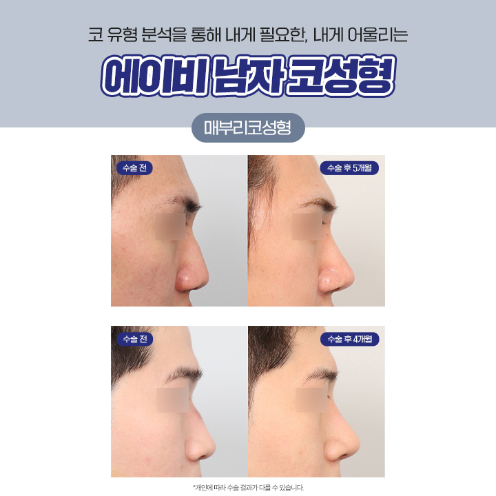 남자코성형후기 라면 여기지 관련 이미지 4